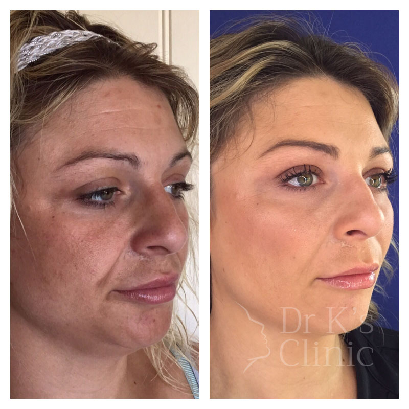 Ladies Facelifts & Anti-Aging Treatments In Chester & Wrexham