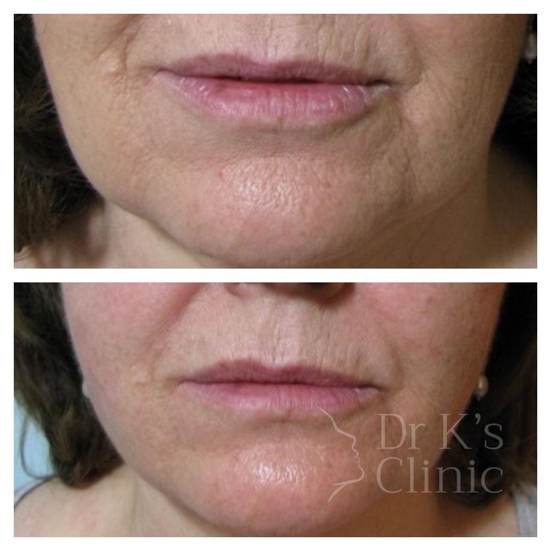 Before and after photo of Thread Lift