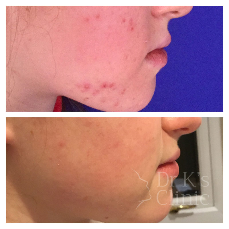 Before and after photo of medical grade skin care in Chester