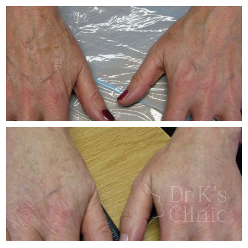 Before and after photo of dermal bio-stimulators